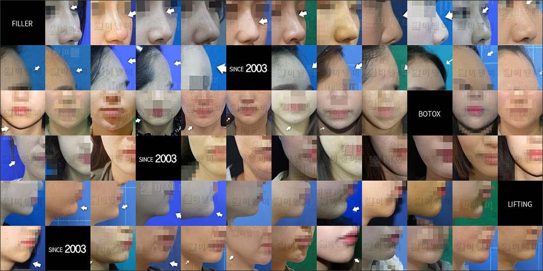 SINCE 2003 MI&MI, 시술후사진모음 구월동보톡스, 인천보톡스, 구월동사각턱보톡스, 인천사각턱보톡스, 구월동턱보톡스, 인천턱보톡스, 구월동주름보톡스, 인천주름보톡스, 구월동이마보톡스, 인천이마보톡스, 구월동눈가보톡스, 인천눈가보톡스, 구월동미간보톡스, 인천미간보톡스, 구월동종아리보톡스, 인천종아리보톡스, 구월동승모근보톡스, 인천승모근보톡스
