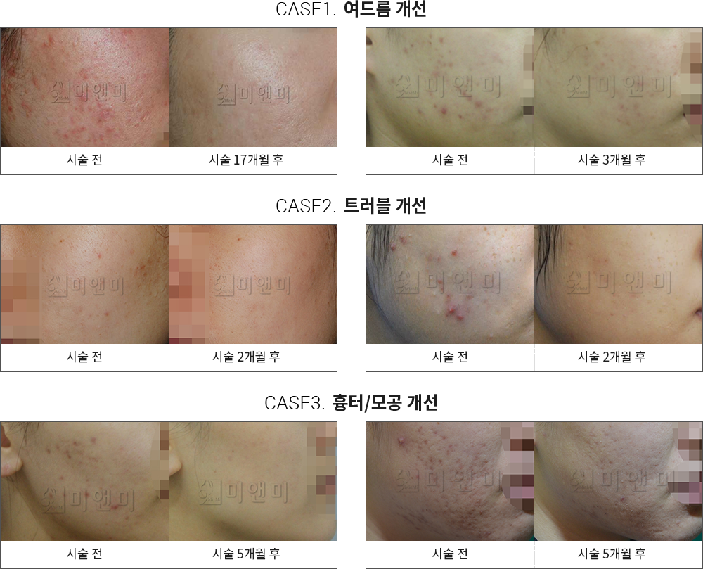 시술전후사진 : 구월동여드름, 인천여드름, 구월동여드름흉터, 인천여드름흉터, 구월동MTS, 인천MTS, 구월동PDT, 인천PDT, 구월동알라딘필, 인천알라딘필, 구월동모공, 인천모공