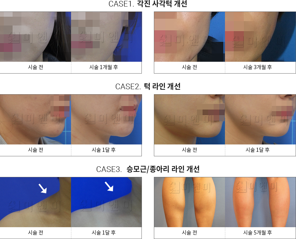 시술전후사진 승모근 보톡스 : 각진 사각턱 개선,턱 라인 개선,승모근/종아리 라인 개선 구월동승모근보톡스, 인천승모근보톡스, 구월동보톡스, 인천보톡스, 구월동종아리보톡스, 인천종아리보톡스, 구월동쫑알주사, 인천쫑알주사