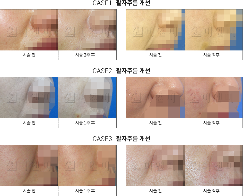 시술전후사진 팔자필러 : 팔자주름 개선 구월동팔자주름필러, 인천팔자주름필러
