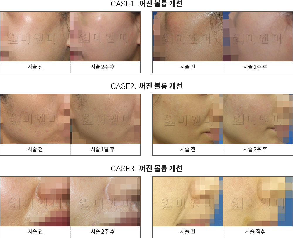 시술전후사진 큐오필 : 꺼진 볼륨 개선 구월동큐오필,인천큐오필,구월동필러,인천필러,구월동코필러,인천코필러,구월동무턱필러,인천무턱필러,구월동볼필러,인천볼필러,구월동이마필러,인천애교필러,구월동팔자주름필러,인천팔자주름필러,구월동입술필러,인천입술필러